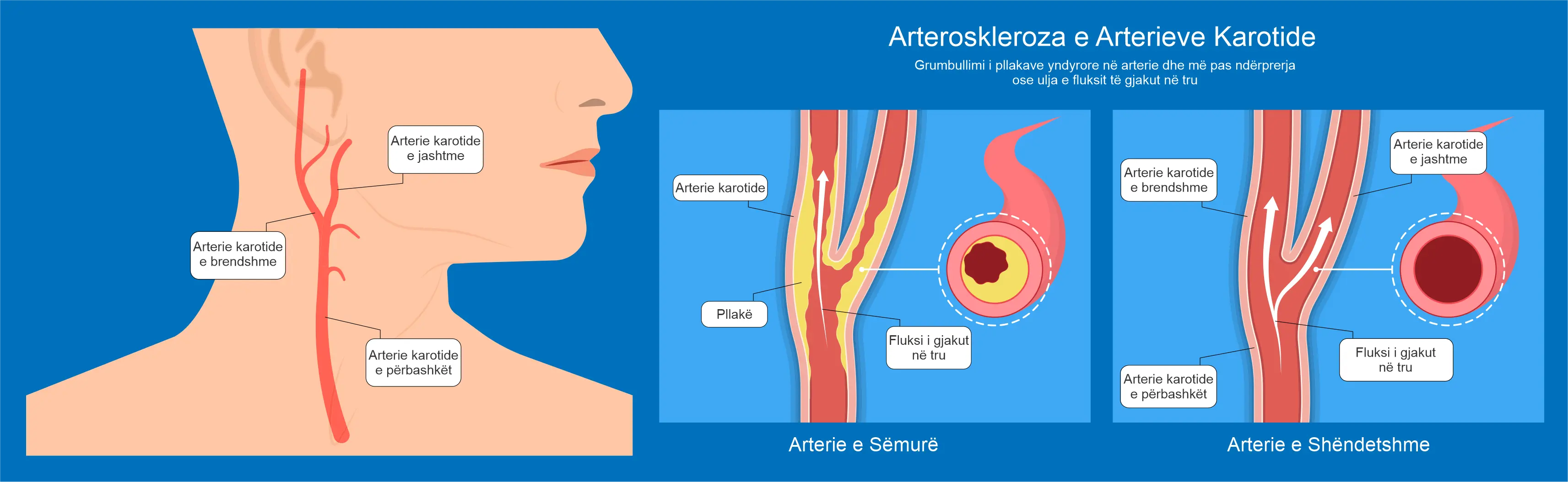 Diagram qe shpjegon arterosklerozen e arterieve karotide dhe ngushtimin e fluksit te gjakut ne tru