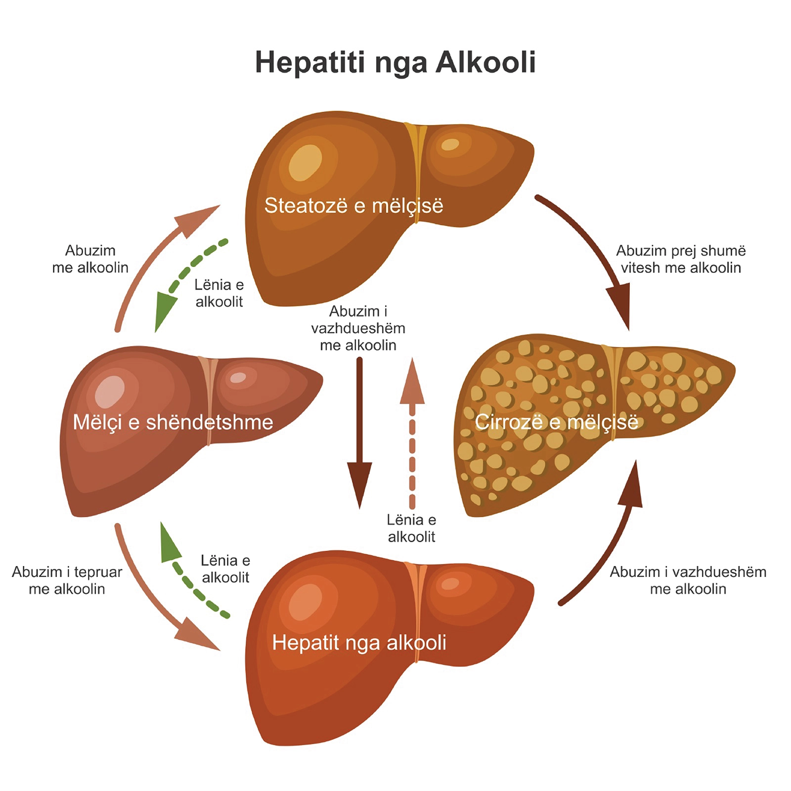 Diagram që tregon progresin e dëmtimit të mëlçisë nga alkooli, nga mëlçia e shëndetshme te steatoza e mëlçisë, hepatiti nga alkooli dhe deri te cirroza e mëlçisë.