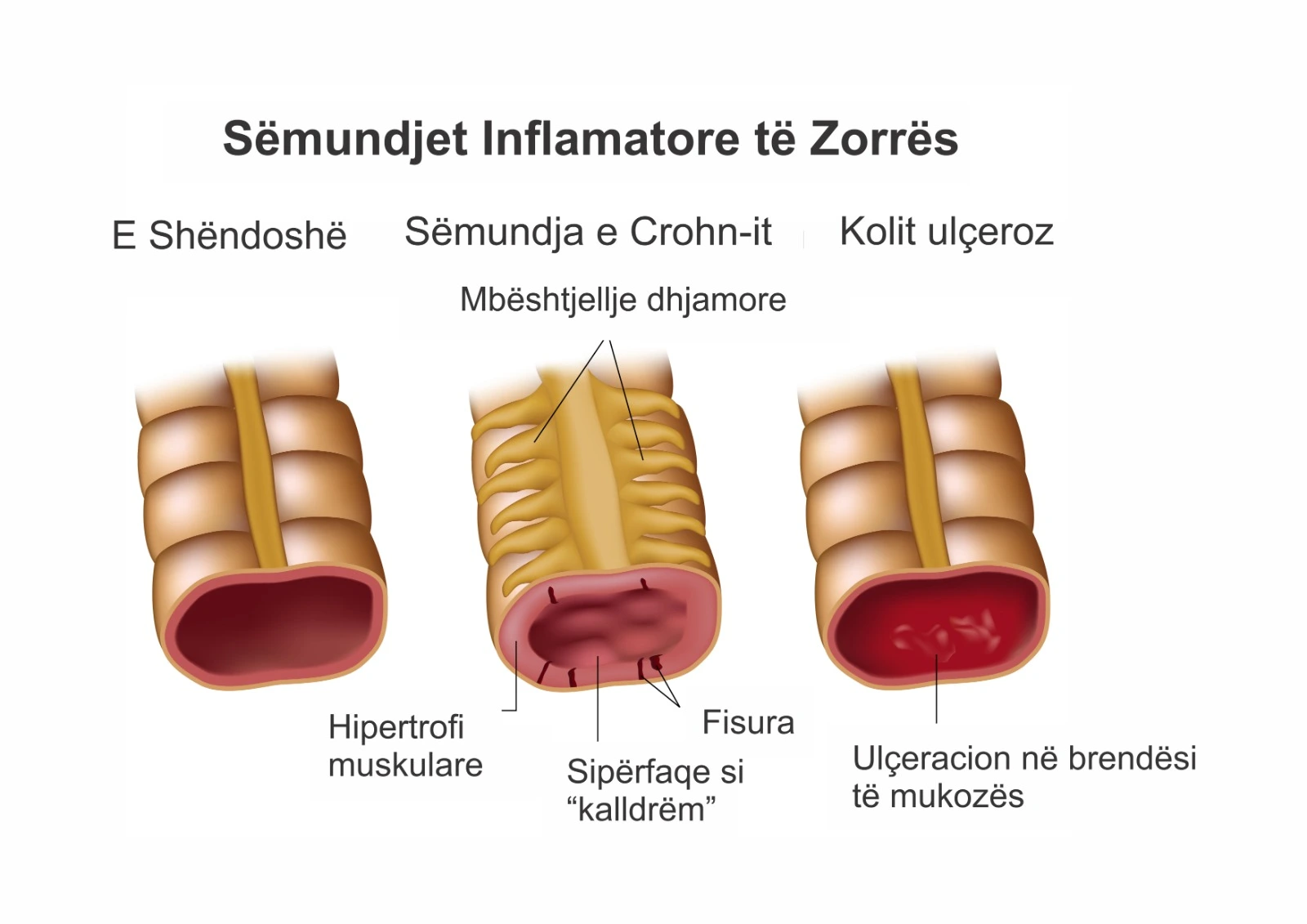 Diagram qe krahason zorren e shendetshme me semundjet inflamatore te zorreve (IBD), duke treguar Crohn dhe kolitin ulceroz